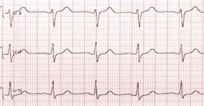 Electrocardiogram